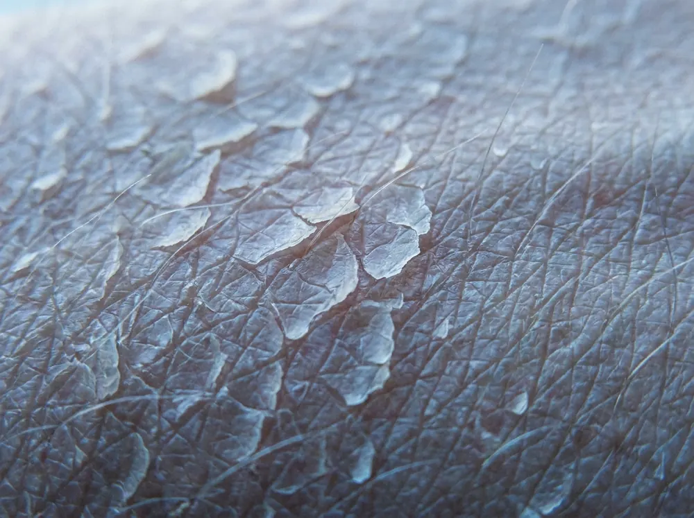 An extreme close view of the skin surface in cold blue daylight, the flat overlapping plates of the outermost layer visible with fine cracks and dry edges lifting between them.