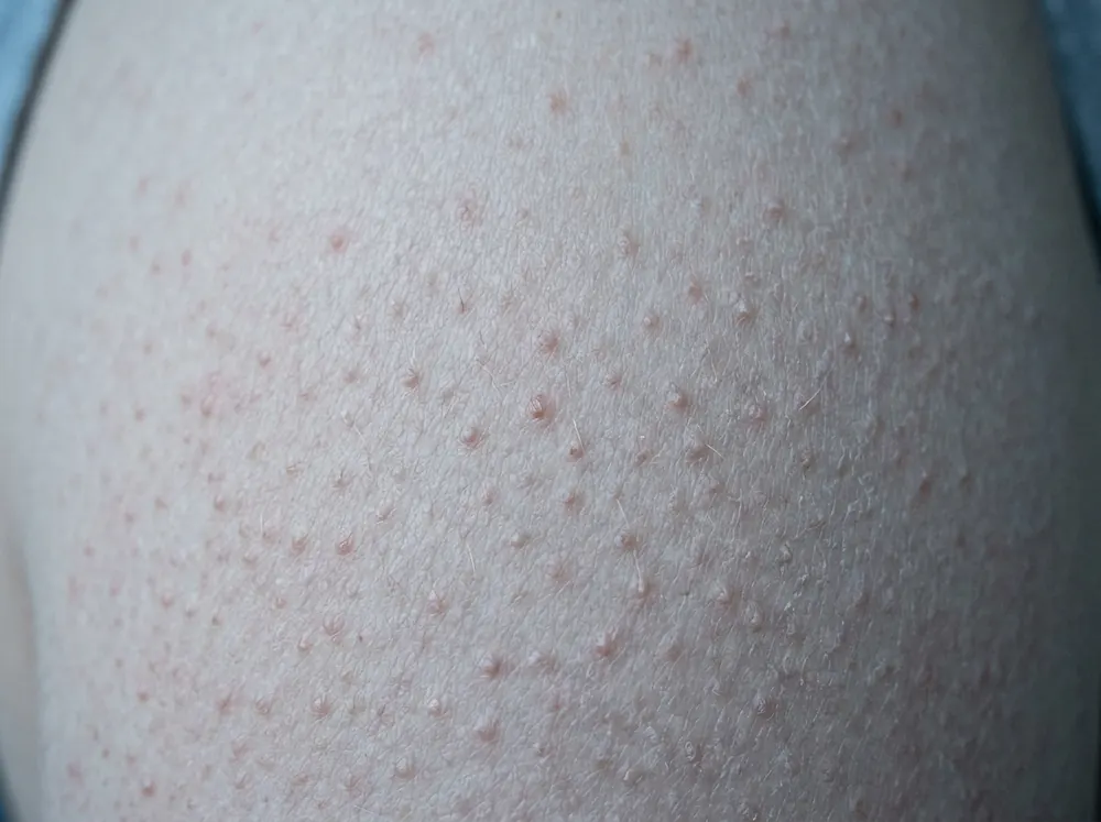 A close view of the back of an upper arm in cool window light, showing fine evenly spaced rough bumps with a central hair in each.
