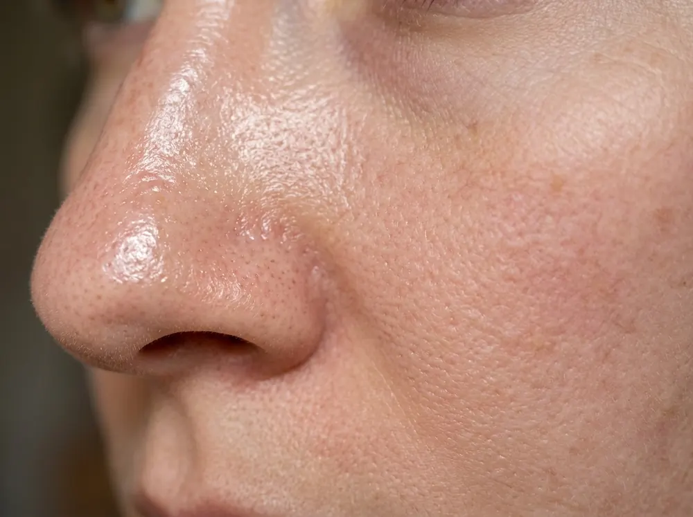 A close view across the nose and cheek showing shine on the nose fading to matte, finely textured skin toward the cheek.