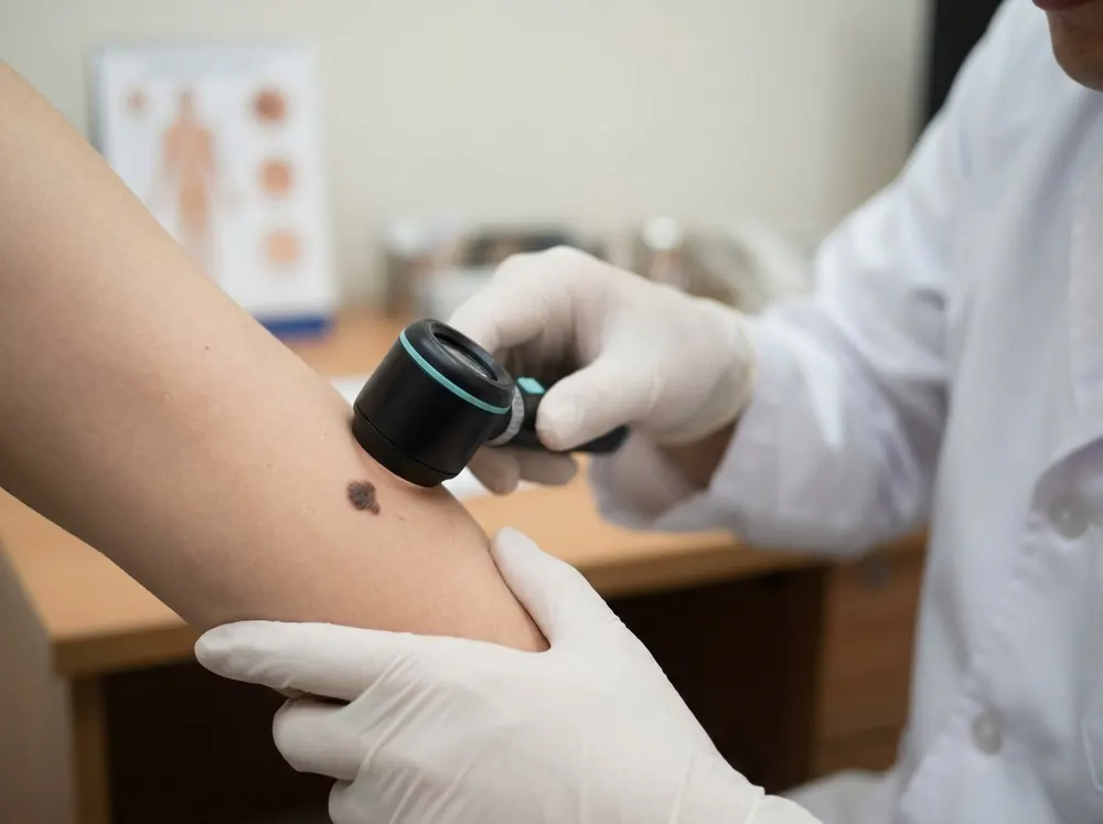 A dermatologist examining a mole on a patient's arm with a dermatoscope
