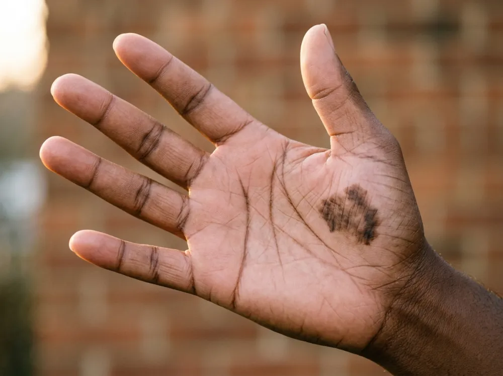An open deep brown palm held up in low warm sunlight against a blurred brick wall, with a dark irregular patch on the heel of the palm.