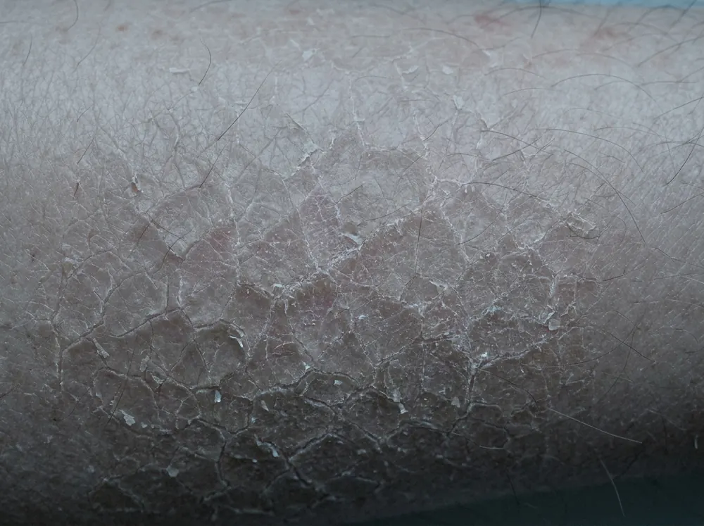 An extreme close view of the skin on a lower shin in dim flat blue-grey light, dry plates of skin separated by fine pale fissures in a cracked-porcelain pattern.