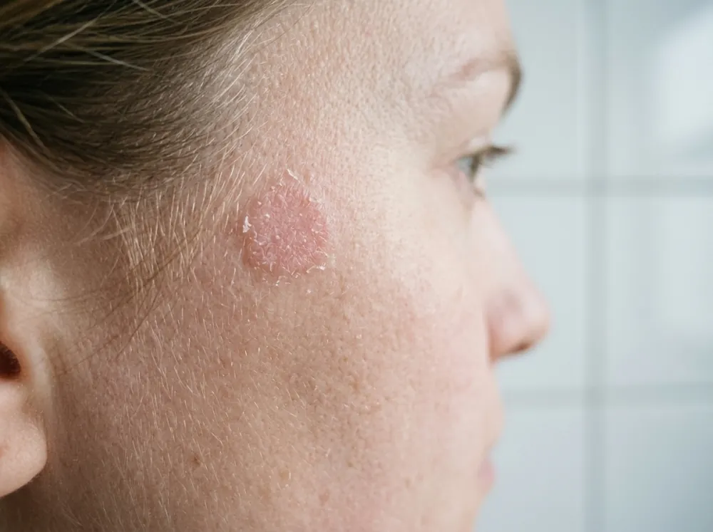 A close side view of a fair cheek near the hairline with a round pink, finely scaly patch and dry skin around it, against a white tiled background.