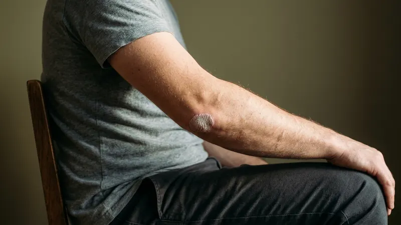 Eczema or Psoriasis? Telling Them Apart by Sight