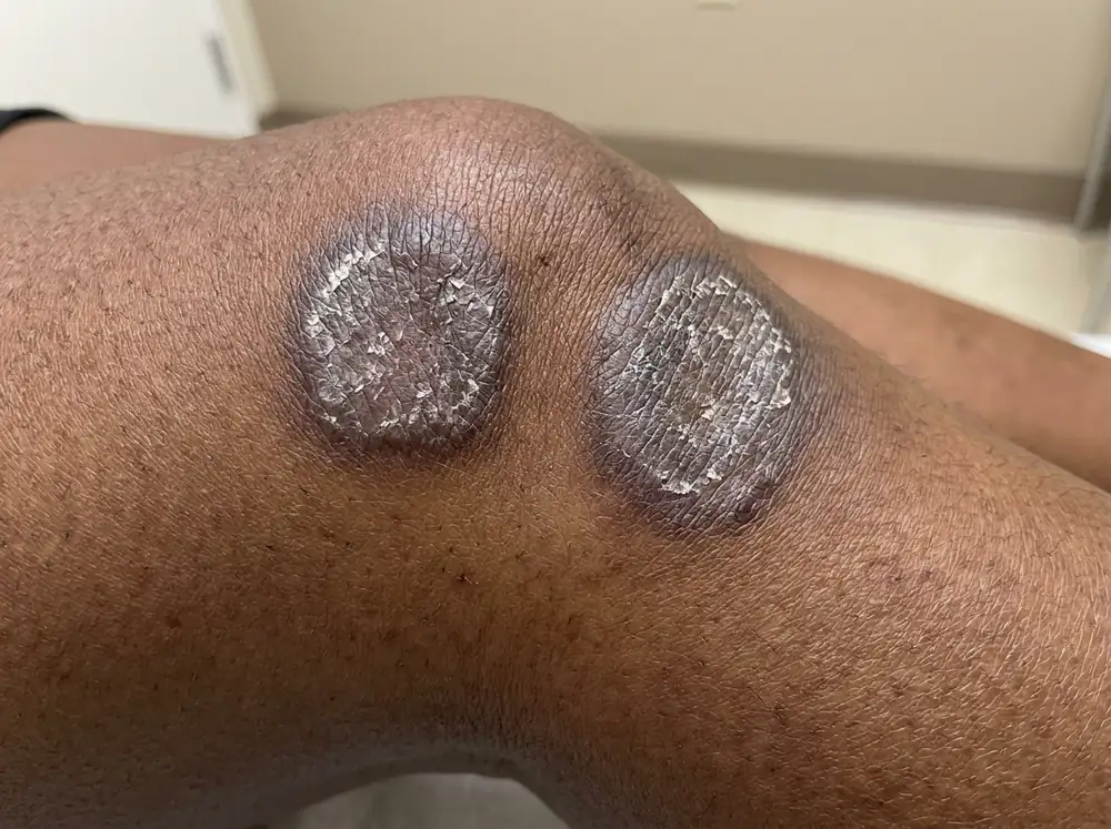 A close view of deep brown skin on a knee, showing thick raised plaques that read violet-grey rather than red, with silvery scale on the surface.