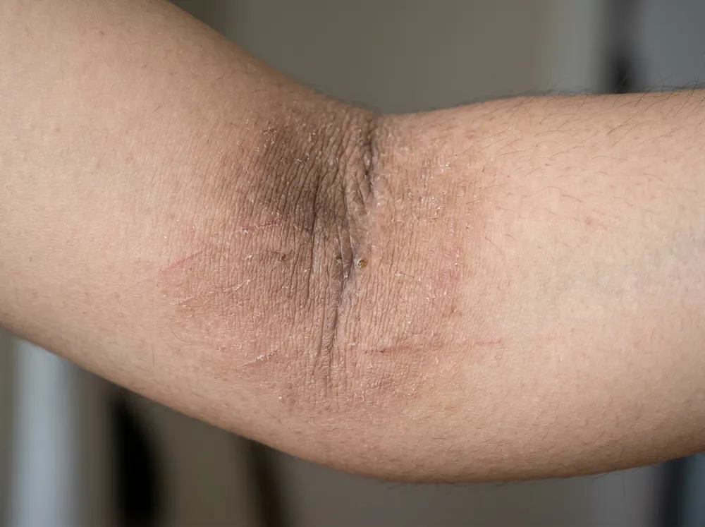A close view of the inner elbow crease showing a thickened, leathery patch with no clear border, fading gradually into surrounding skin.