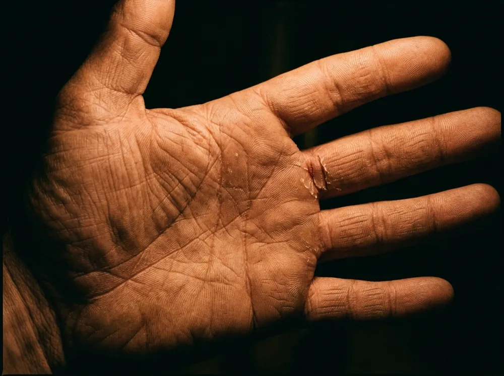An open adult palm in warm light against a dark background, the thick skin crossed by deep creases and fine ridges, with a single narrow crack and dry flakes at the base of one finger.