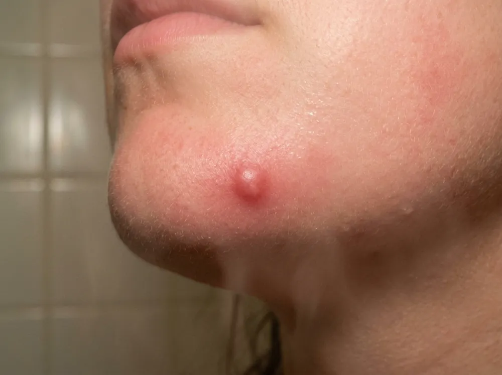 Side view of a chin and jawline with a single red, rounded raised bump, the skin around it flushed pink, against a blurred tiled wall.