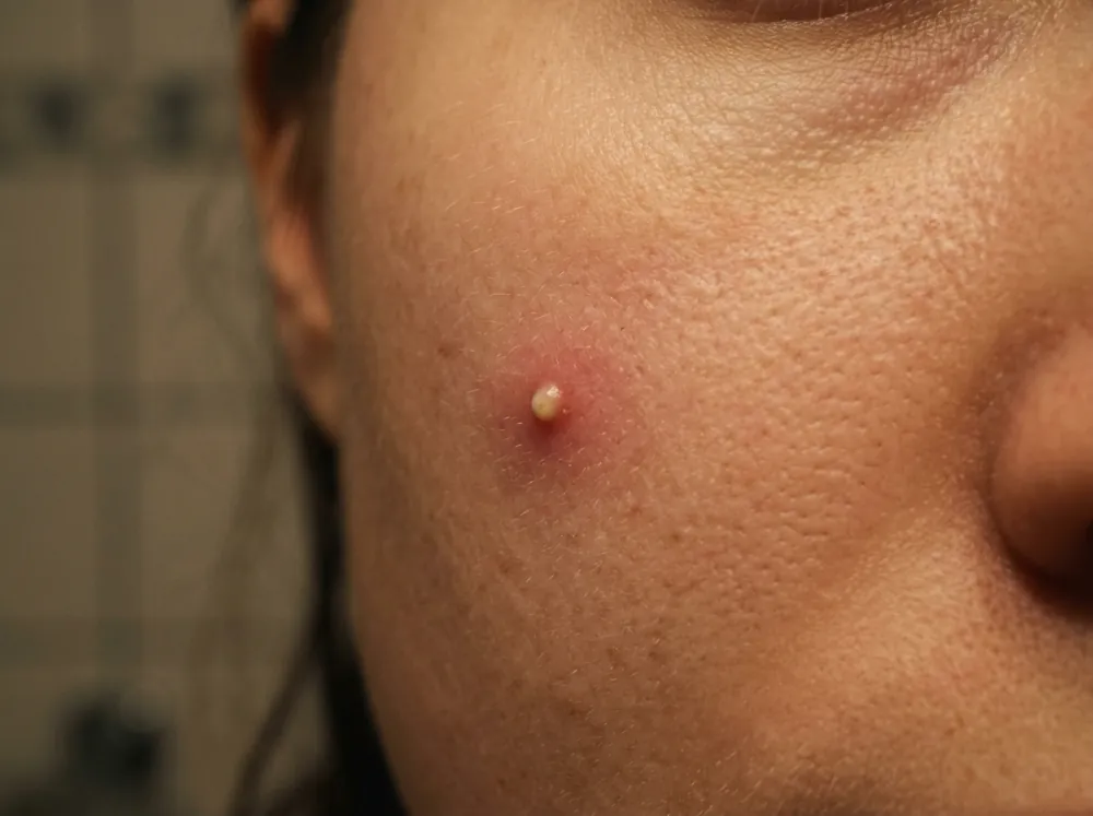 A cheek with a small pustule, a raised red bump with a white-yellow tip centred on a pore and a ring of redness around it.