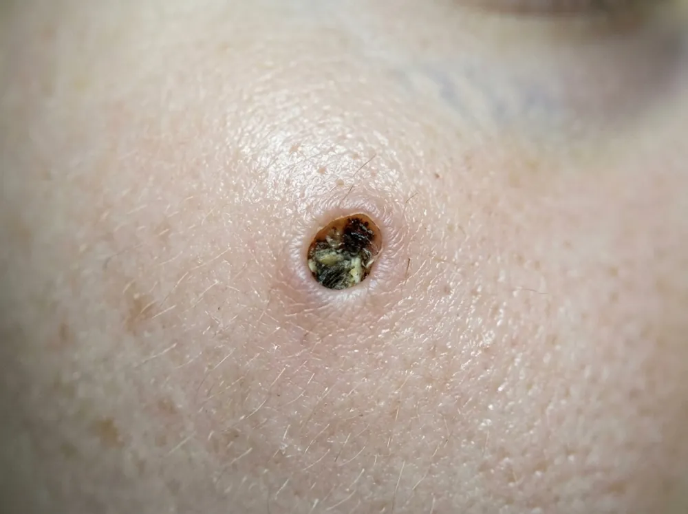 A very close view of a single widened pore on a cheek, filled with a dark and yellowish plug.