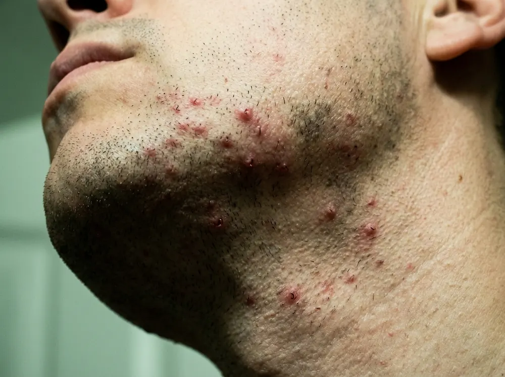 A close view of a man's jaw and upper neck under a harsh overhead strip light, showing a dense scatter of small raised red bumps along the shave line with short dark hairs among them.