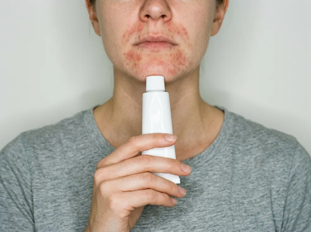 A plain white tube of cream held up in one hand below a reddened lower face under even frontal light, small papules visible around the mouth and chin.