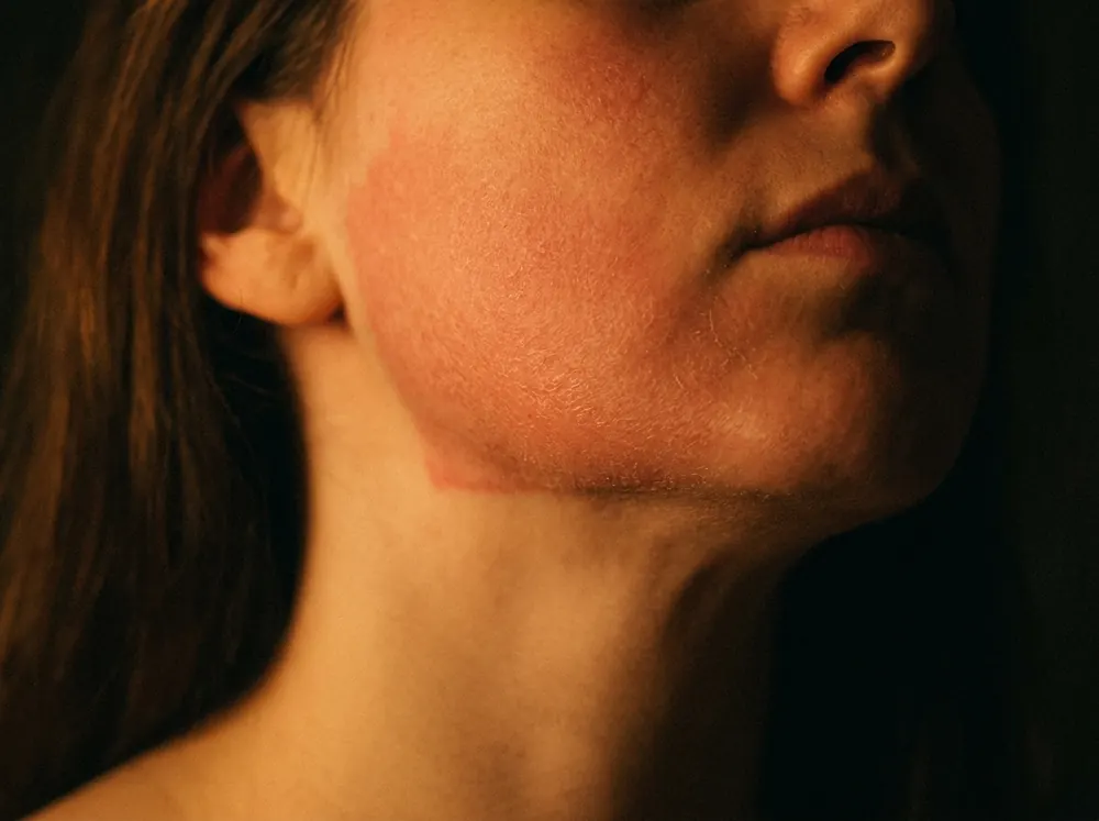 A close view of a woman's lower face at night under a single warm lamp, showing a diffuse red irritated patch with fine scaling that stops in a clear line along her jaw.