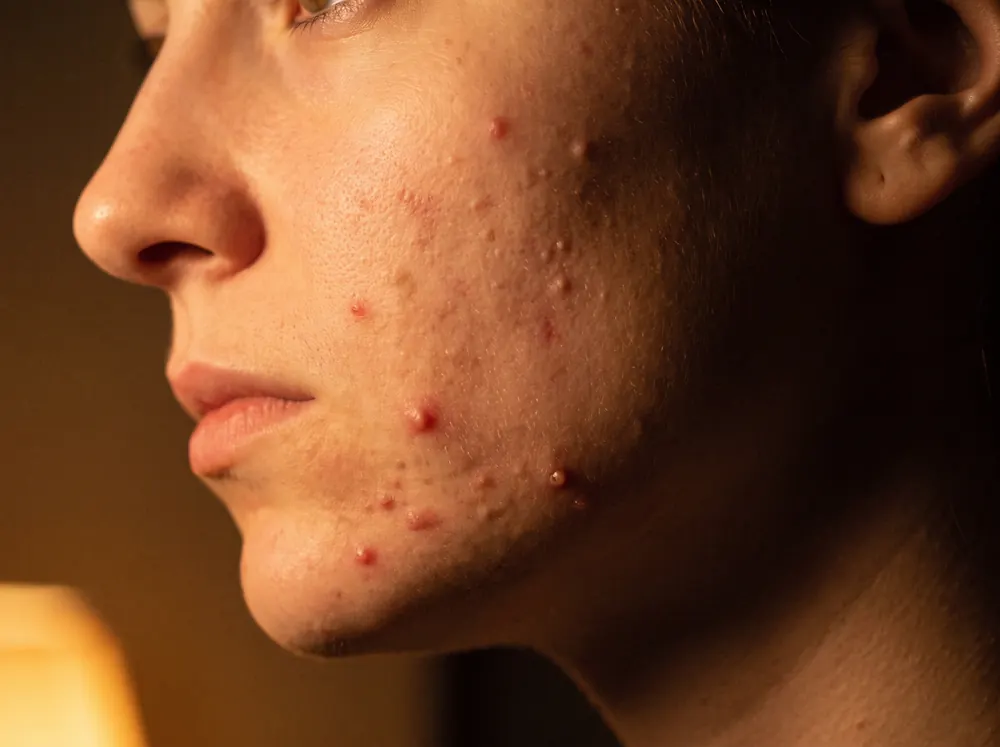 A close view of a woman's cheek and jaw at night under a single warm lamp, showing a mix of raised inflammatory spots and smaller flesh-coloured bumps across the skin.