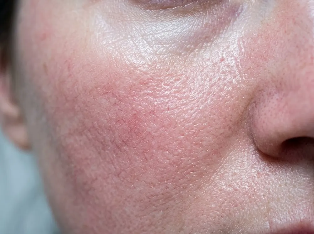 A close view of a cheek and the side of the nose in hard light, showing shiny skin with diffuse redness and fine visible surface vessels.