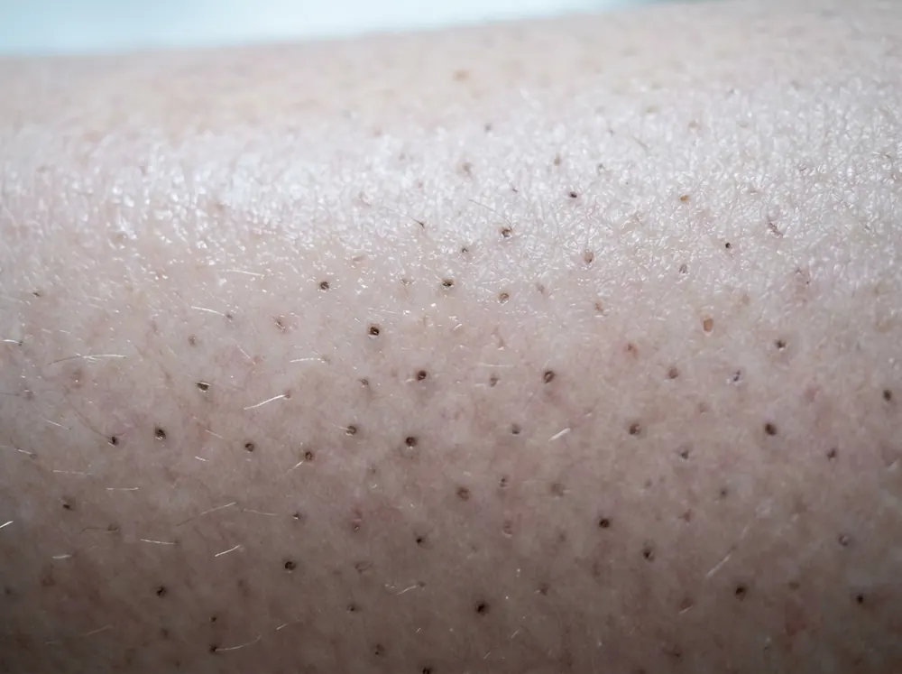 A close view of the skin on a lower leg in bright bathroom light, showing small dark dots set into the follicular openings.