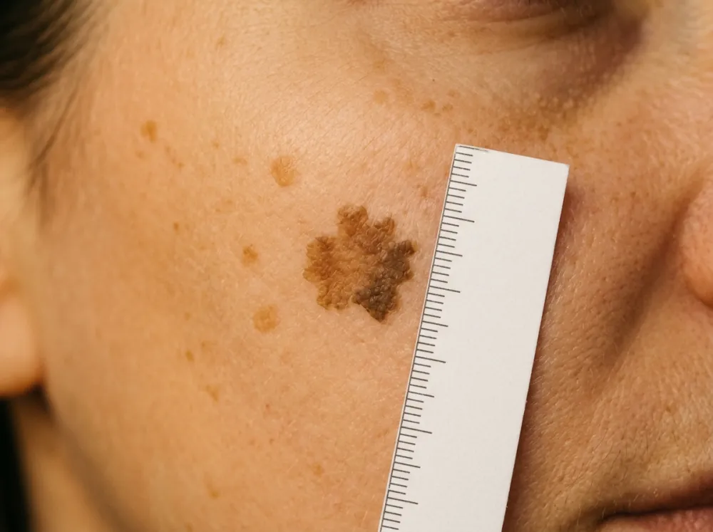 A single flat brown patch on a cheek with an uneven, scalloped edge and two shades of brown, beside a few smaller tan spots and a paper ruler, lit from the front by warm low sun.