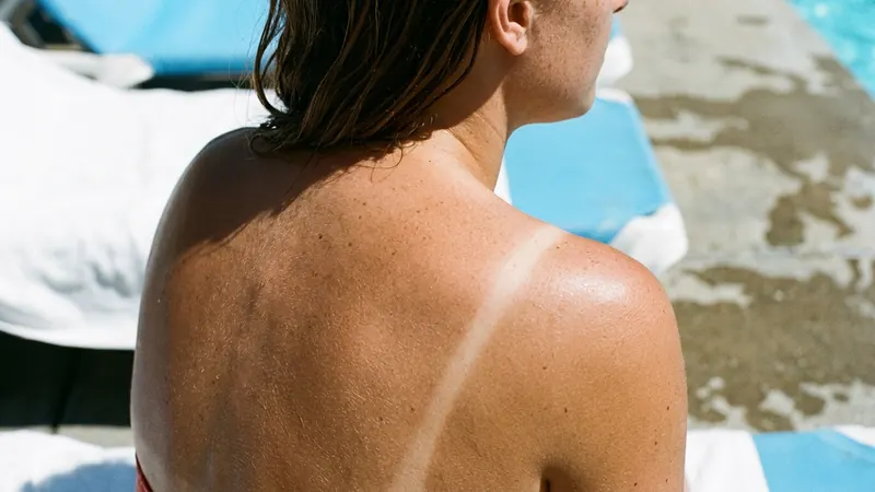 A shoulder in hard midday sunlight showing a crisp pale strap line against visibly tanned skin on either side.