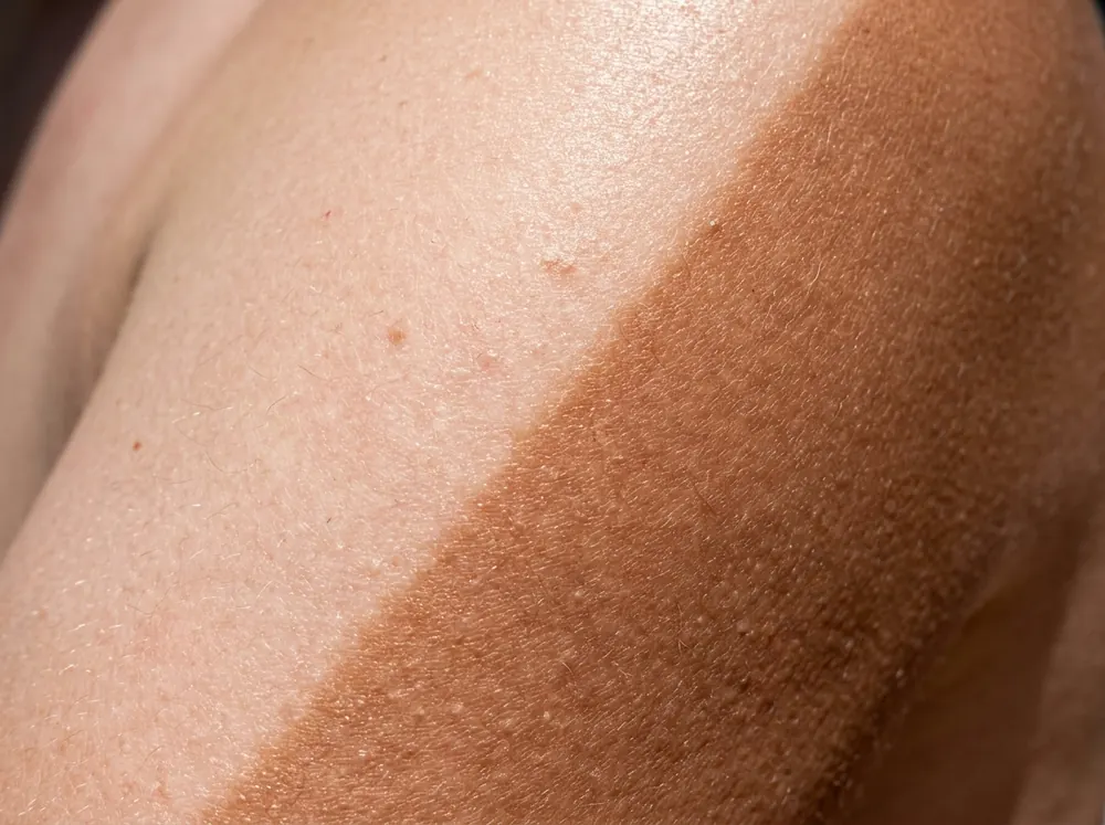 A close view of a sharp tan line across a shoulder in hard midday sunlight, the skin noticeably darker on one side of the boundary.