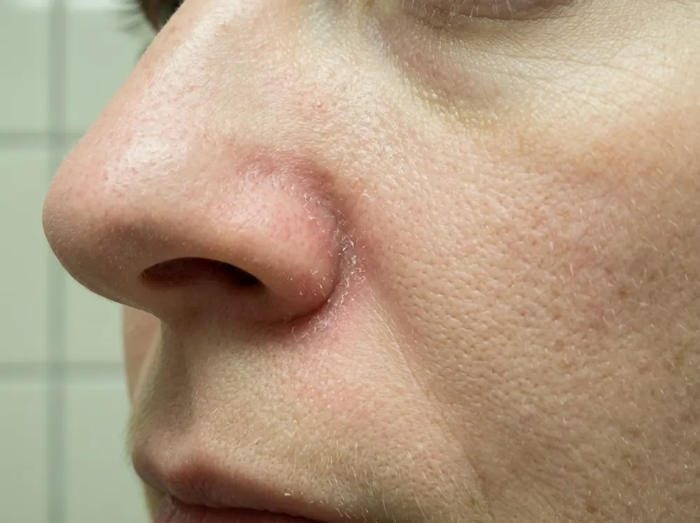 Close side view of a nose and cheek, with mild redness and fine flaking along the crease beside the nostril, and fine pores and peach fuzz visible.