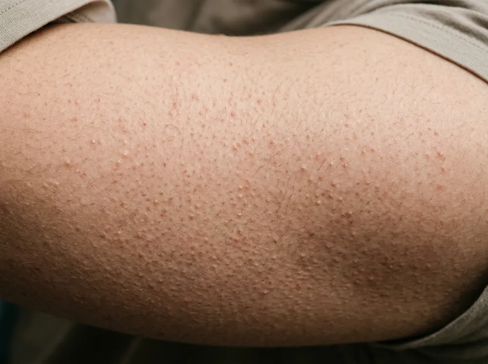 A close view of an upper arm covered in small, rough, skin-coloured bumps around the hair follicles, a few faintly red.